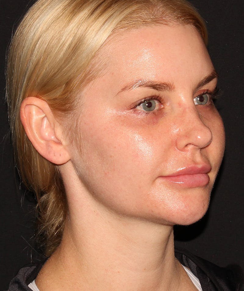 Neck Liposuction Before & After Gallery - Patient 187749739 - Image 1