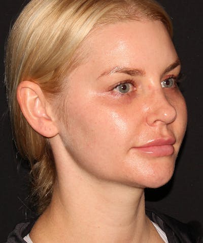 Neck Liposuction Before & After Gallery - Patient 187749739 - Image 1