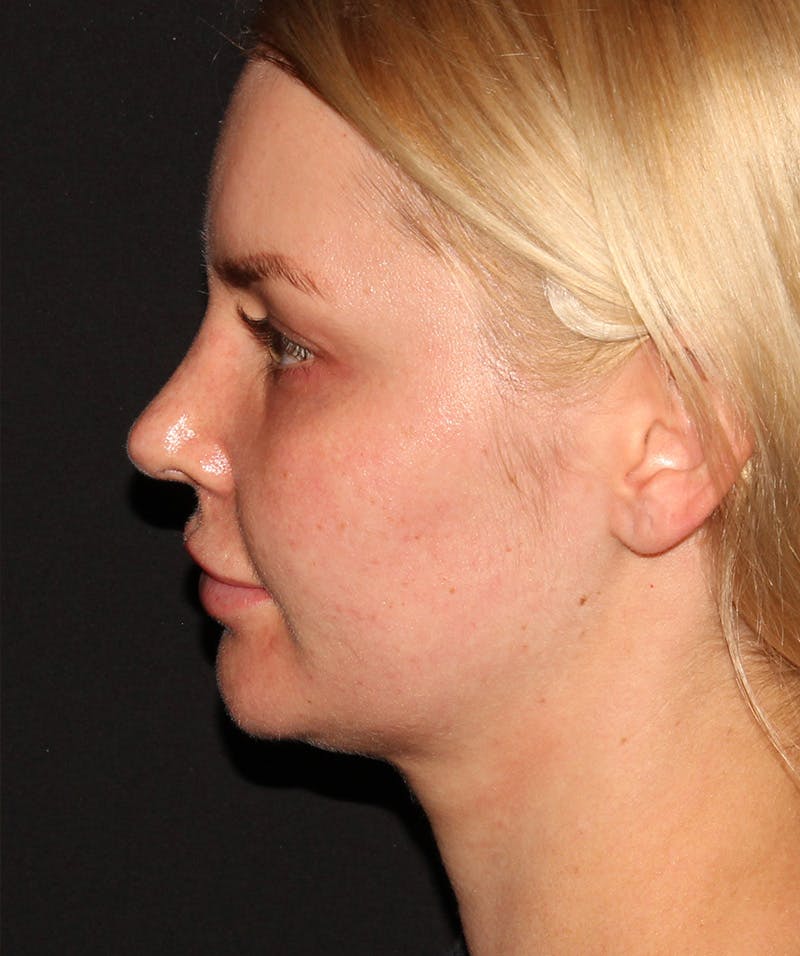 Neck Liposuction Before & After Gallery - Patient 187749739 - Image 3