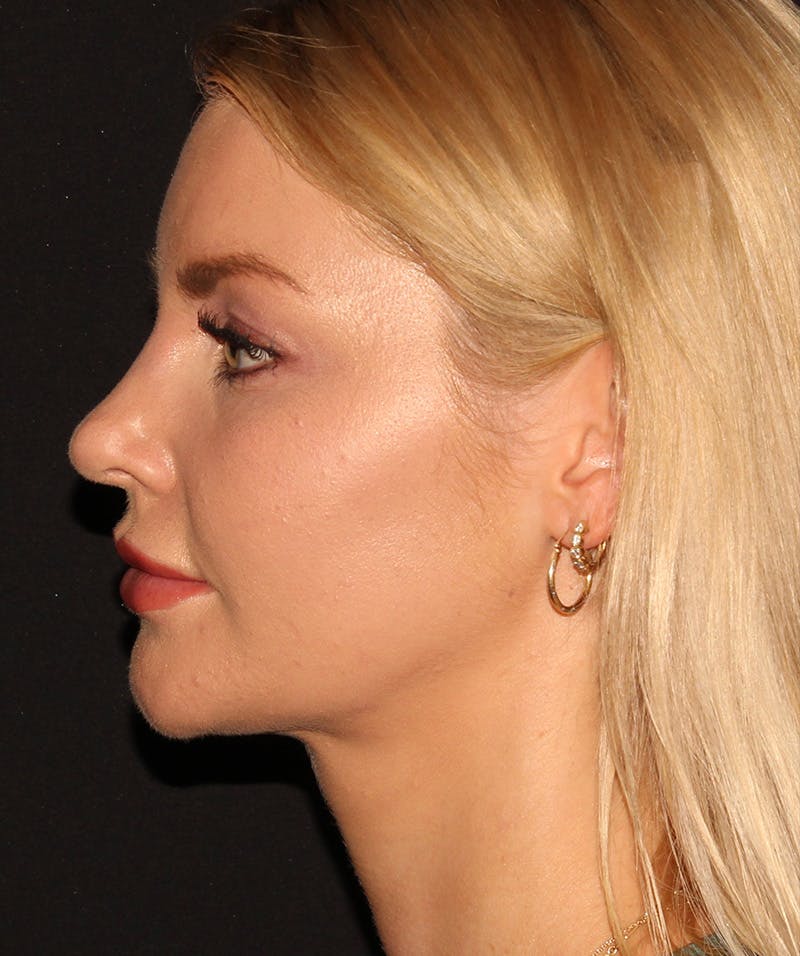 Neck Liposuction Before & After Gallery - Patient 187749739 - Image 4