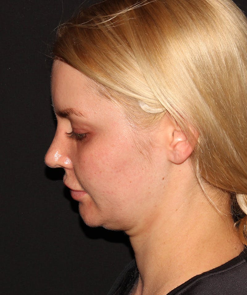 Neck Liposuction Before & After Gallery - Patient 187749739 - Image 5