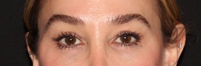 Eyelid Surgery Before & After Gallery - Patient 187759851 - Image 1