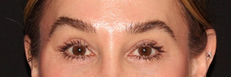 Eyelid Surgery Before & After Gallery - Patient 187759851 - Image 2