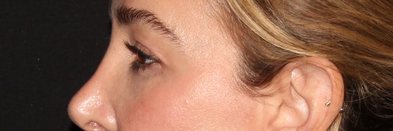 Eyelid Surgery Before & After Gallery - Patient 187759851 - Image 3