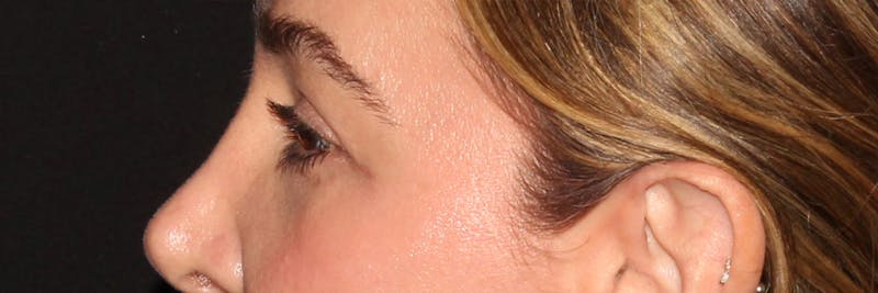 Eyelid Surgery Before & After Gallery - Patient 187759851 - Image 4
