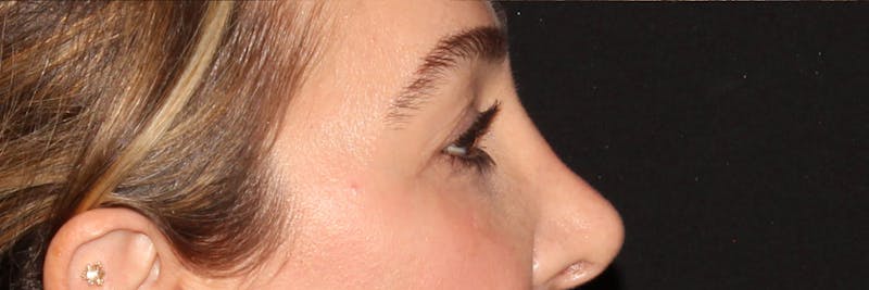 Eyelid Surgery Before & After Gallery - Patient 187759851 - Image 5