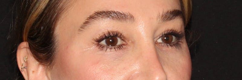 Eyelid Surgery Before & After Gallery - Patient 187759851 - Image 7
