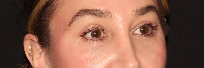 Eyelid Surgery Before & After Gallery - Patient 187759851 - Image 8