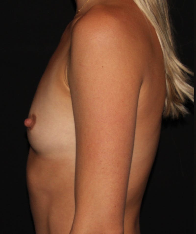 Breast Augmentation Before & After Gallery - Patient 187766627 - Image 5