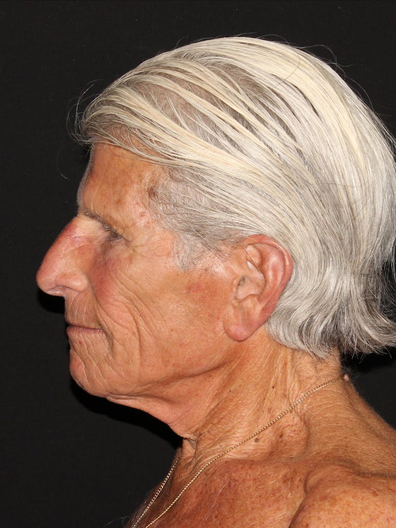 Facelift & Necklift Before & After Gallery - Patient 187766653 - Image 3
