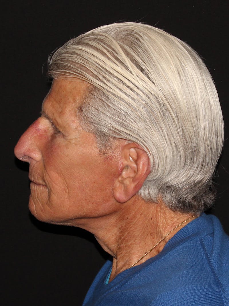 Facelift & Necklift Before & After Gallery - Patient 187766653 - Image 4