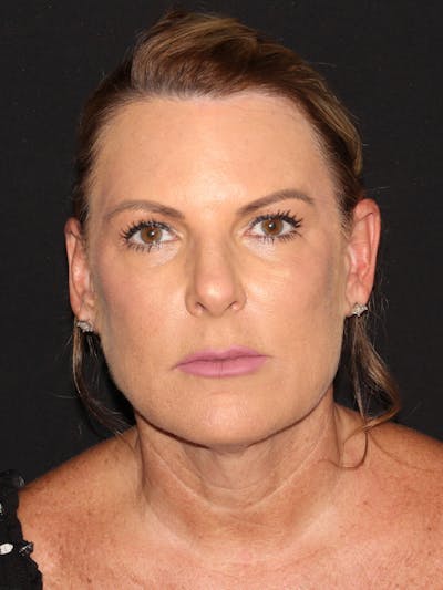 Facelift & Necklift Before & After Gallery - Patient 187767461 - Image 1