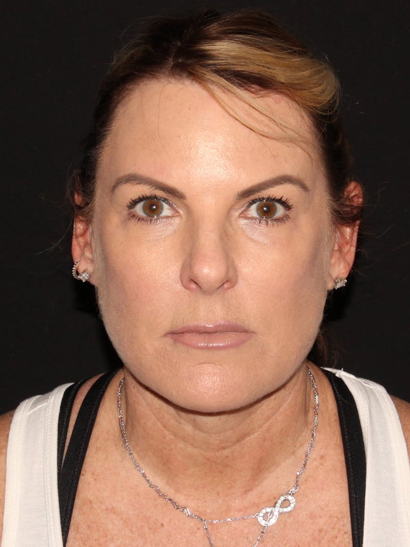 Facelift & Necklift Before & After Gallery - Patient 187767461 - Image 2