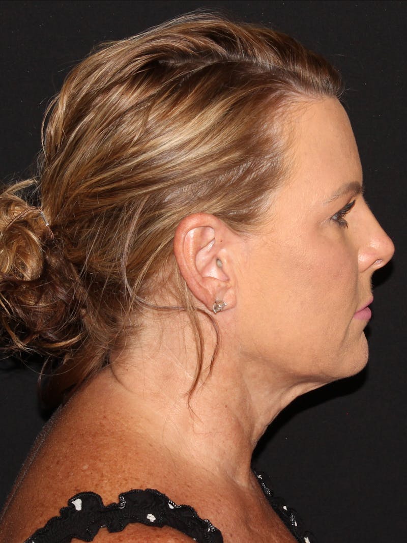 Facelift & Necklift Before & After Gallery - Patient 187767461 - Image 3
