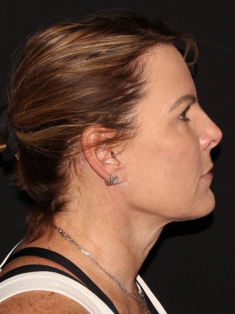 Facelift & Necklift Before & After Gallery - Patient 187767461 - Image 4