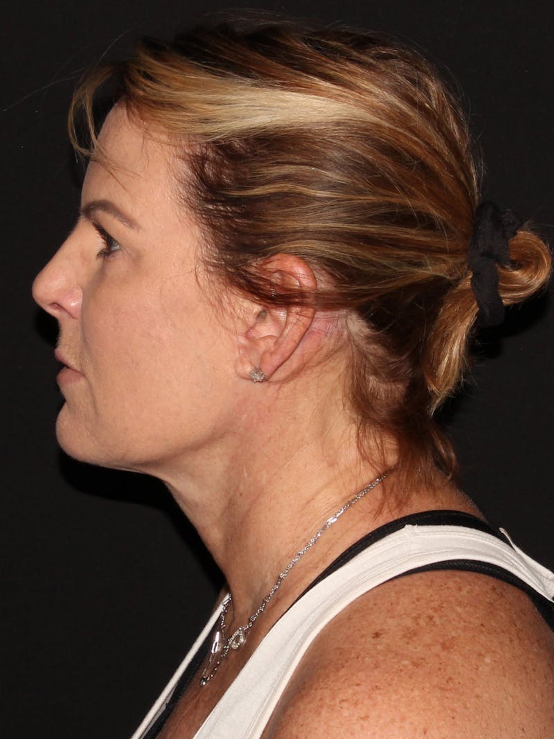 Facelift & Necklift Before & After Gallery - Patient 187767461 - Image 6