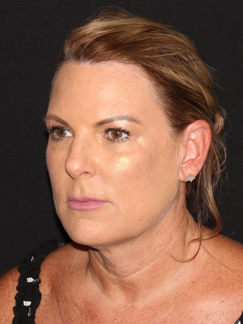 Facelift & Necklift Before & After Gallery - Patient 187767461 - Image 7