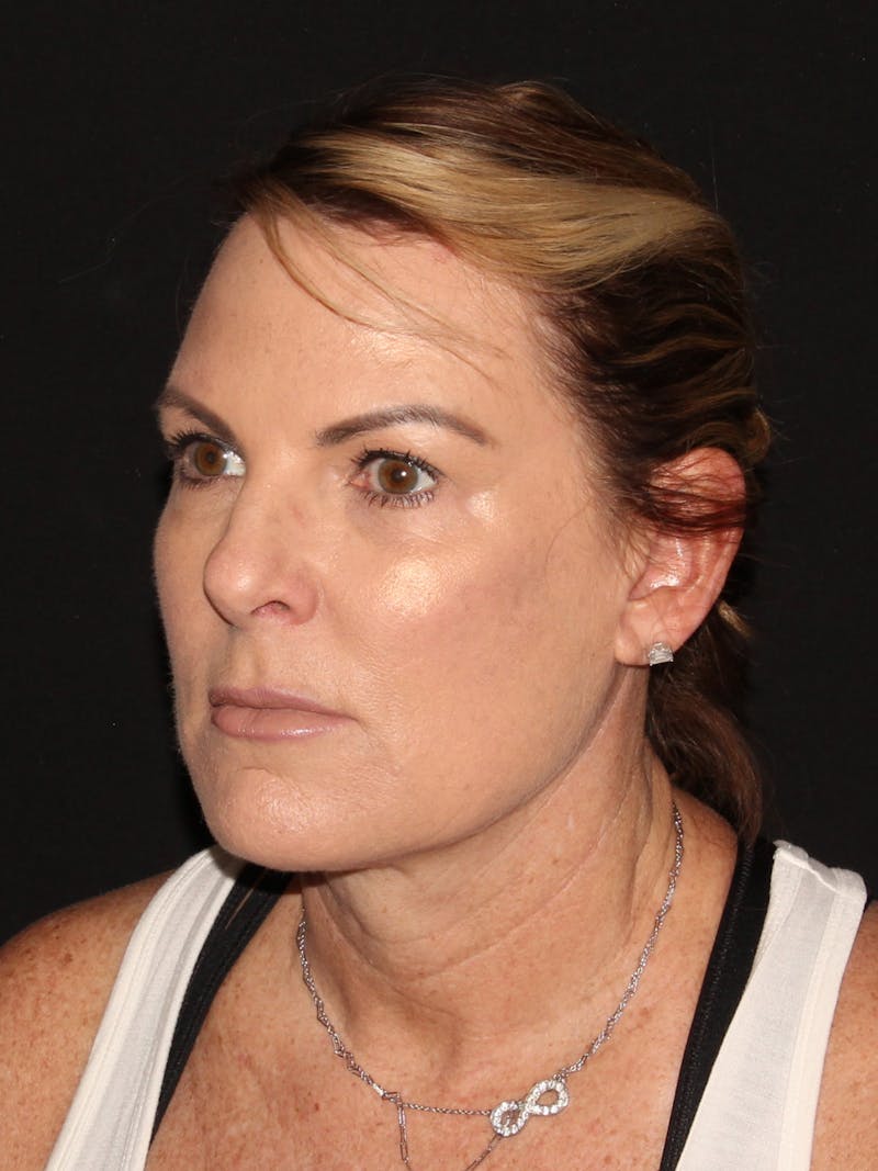 Facelift & Necklift Before & After Gallery - Patient 187767461 - Image 8