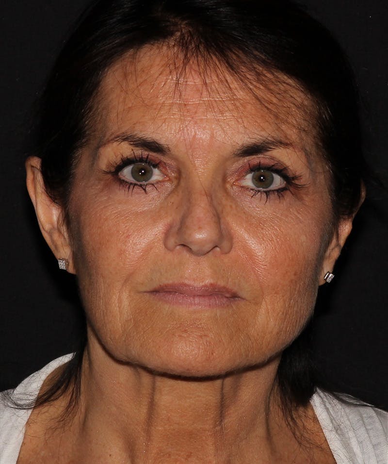 Facelift & Necklift Before & After Gallery - Patient 187767735 - Image 1