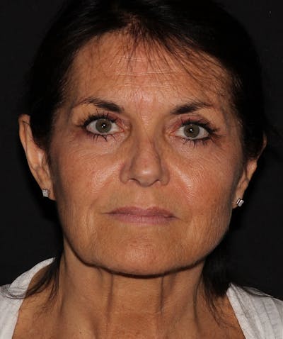 Laser Resurfacing Before & After Gallery - Patient 187767736 - Image 1