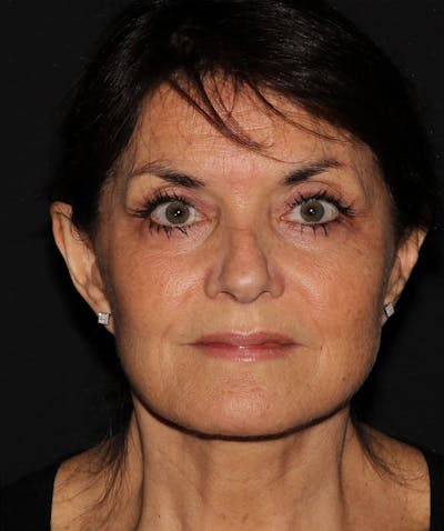 Facelift & Necklift Before & After Gallery - Patient 187767735 - Image 2