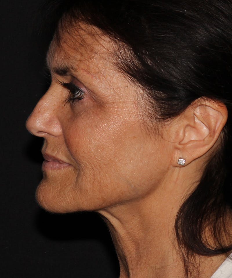 Facelift & Necklift Before & After Gallery - Patient 187767735 - Image 5