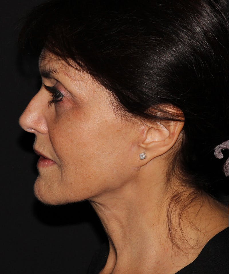 Facelift & Necklift Before & After Gallery - Patient 187767735 - Image 6