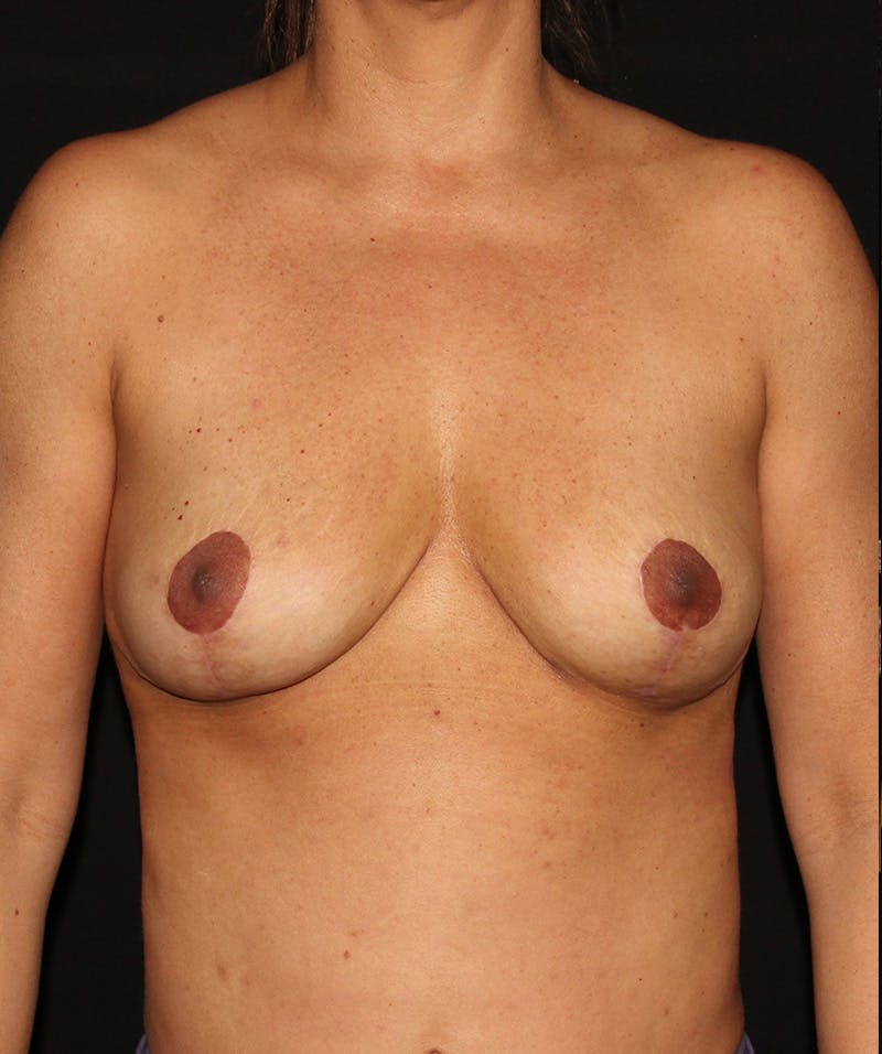 Breast Implant Removal Before & After Gallery - Patient 187767768 - Image 2