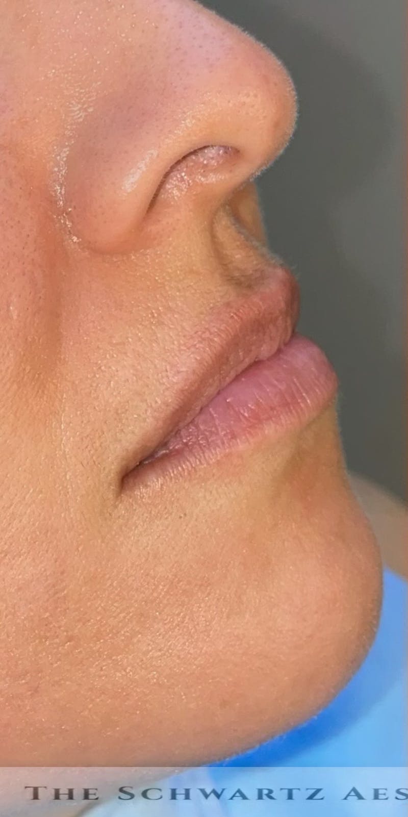Lip Enhancement Before & After Gallery - Patient 955479 - Image 1