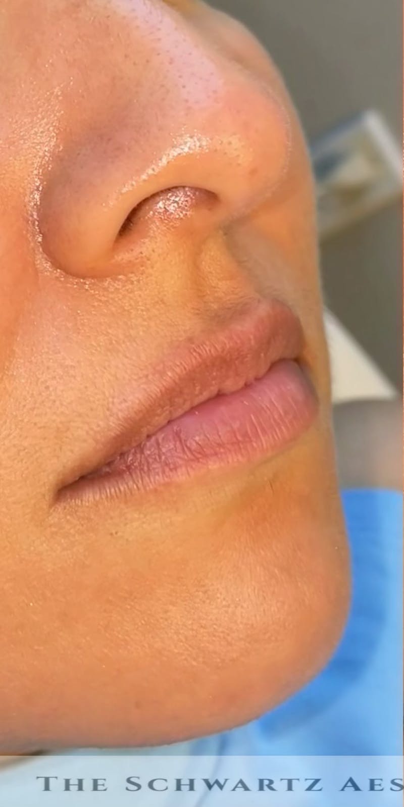 Lip Enhancement Before & After Gallery - Patient 955479 - Image 3