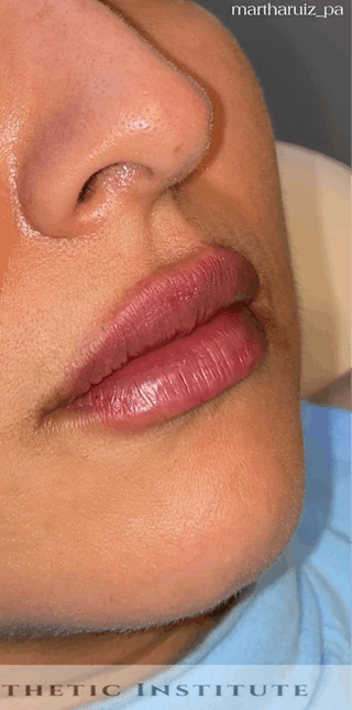 Lip Enhancement Before & After Gallery - Patient 955479 - Image 4