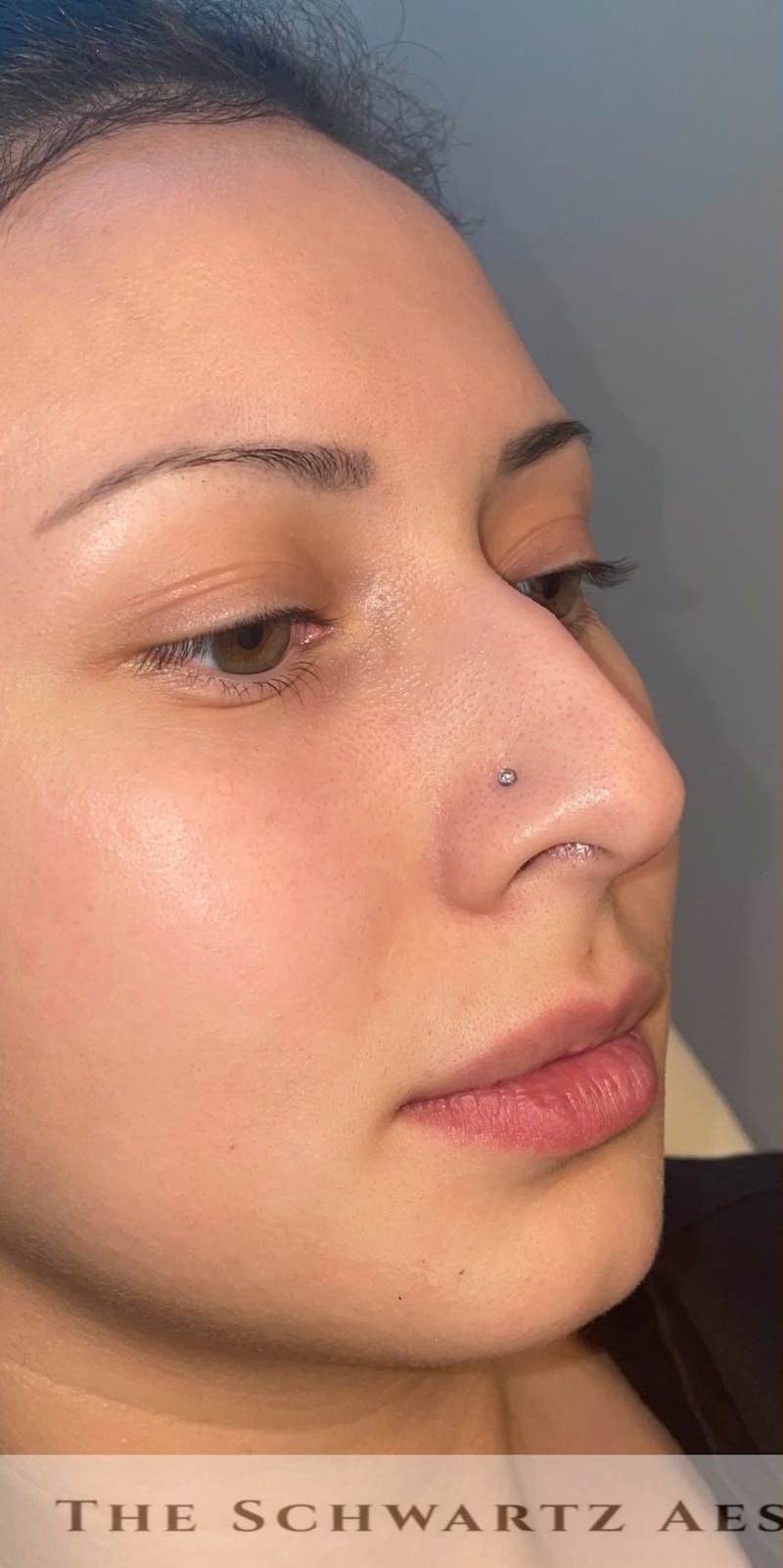 Lip Enhancement Before & After Gallery - Patient 317964 - Image 1