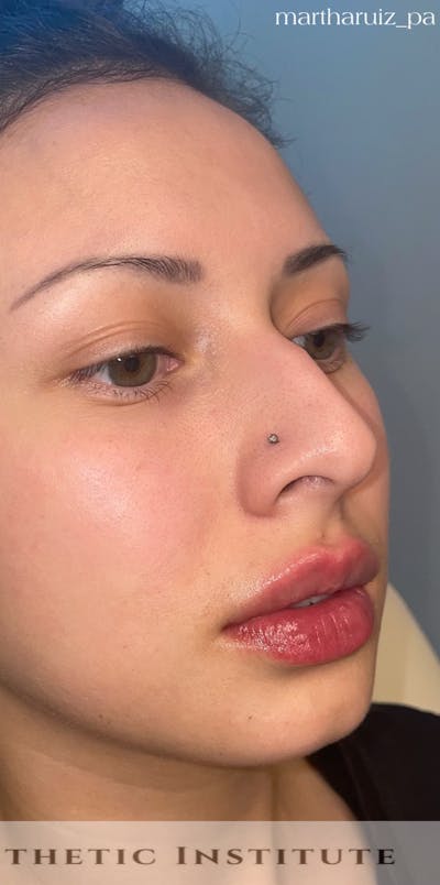 Lip Enhancement Before & After Gallery - Patient 317964 - Image 2