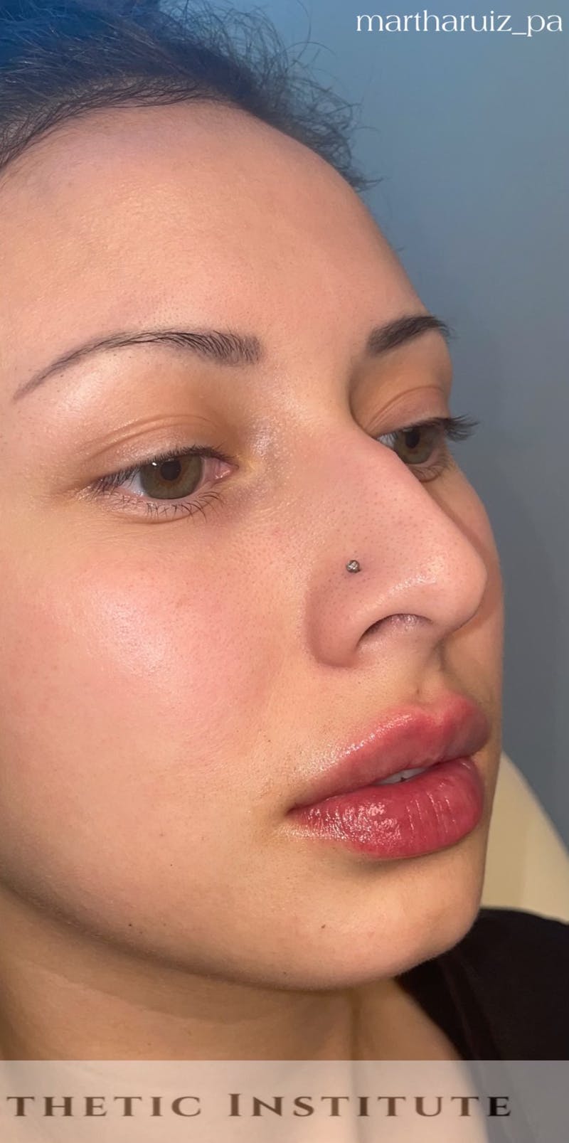 Lip Enhancement Before & After Gallery - Patient 317964 - Image 2
