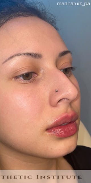 Lip Enhancement Before & After Gallery - Patient 317964 - Image 2