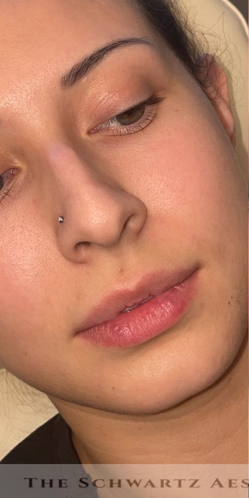 Lip Enhancement Before & After Gallery - Patient 317964 - Image 3