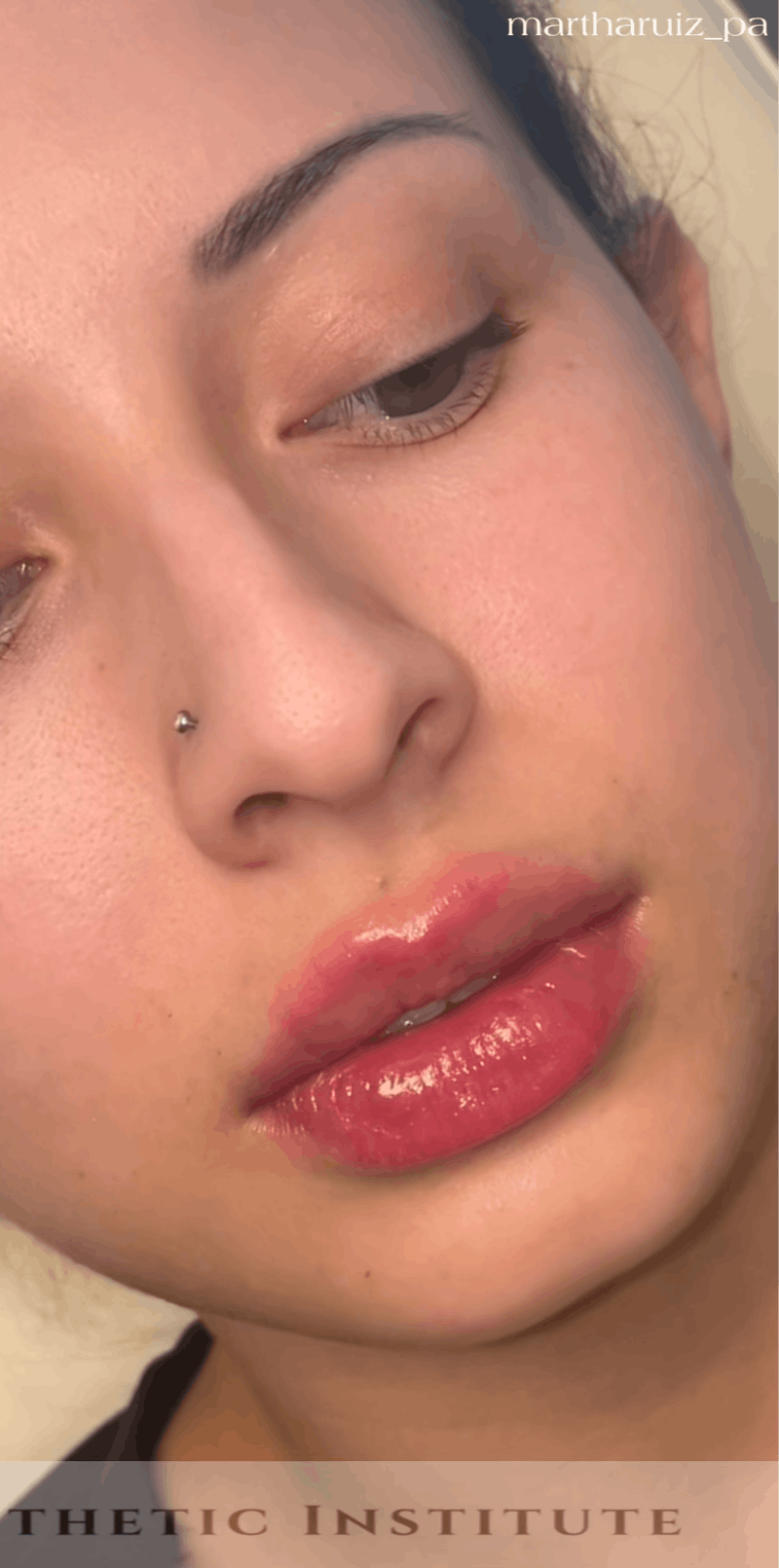 Lip Enhancement Before & After Gallery - Patient 317964 - Image 4
