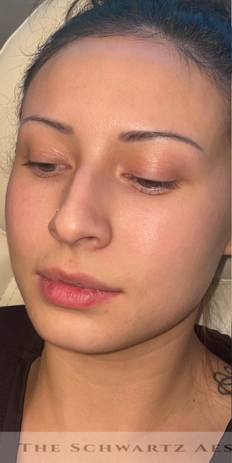 Lip Enhancement Before & After Gallery - Patient 317964 - Image 5