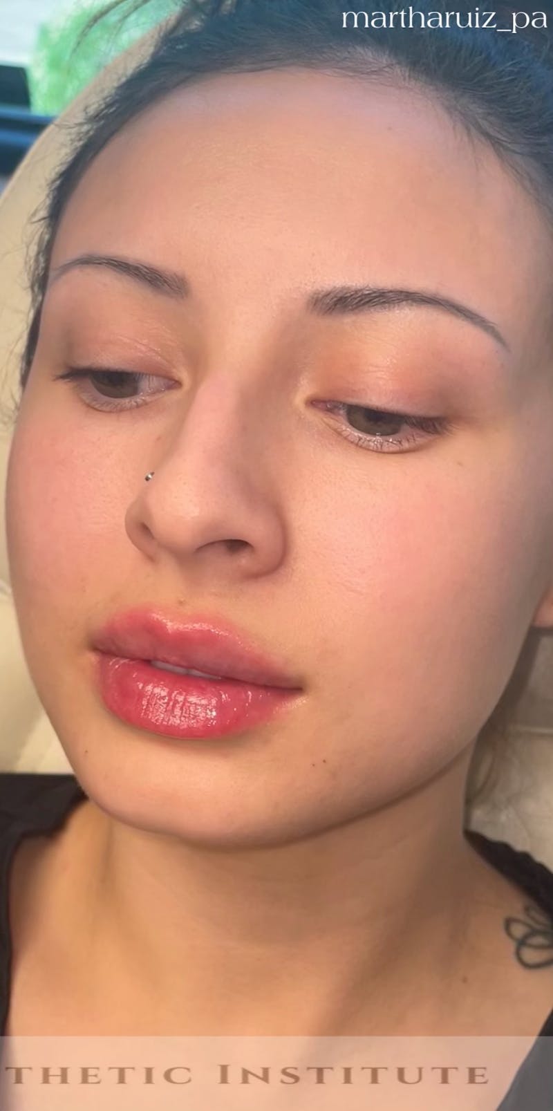 Lip Enhancement Before & After Gallery - Patient 317964 - Image 6