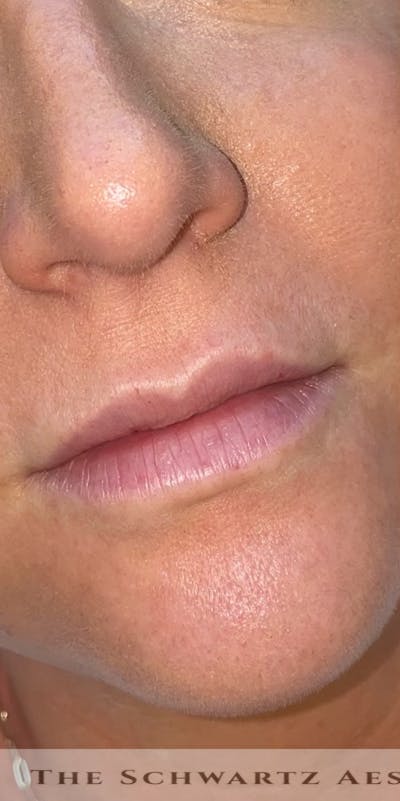 Lip Enhancement Before & After Gallery - Patient 179684 - Image 1