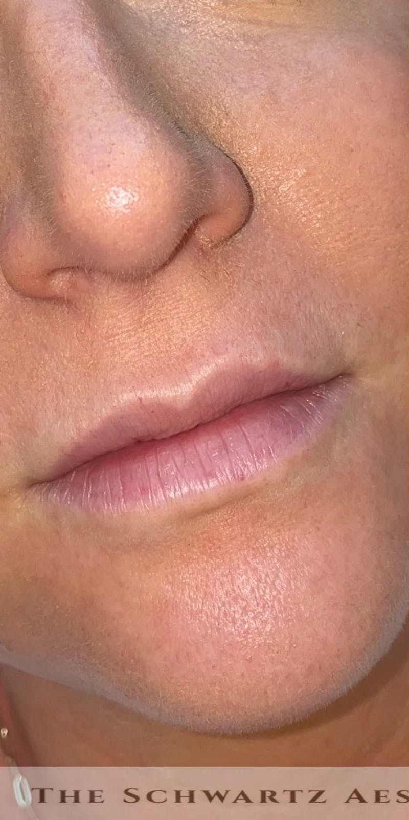 Lip Enhancement Before & After Gallery - Patient 179684 - Image 1