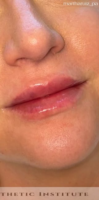 Lip Enhancement Before & After Gallery - Patient 179684 - Image 2