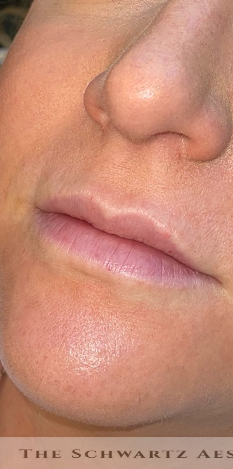 Lip Enhancement Before & After Gallery - Patient 179684 - Image 3