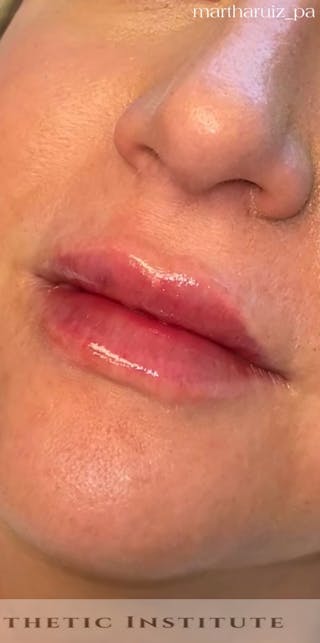 Lip Enhancement Before & After Gallery - Patient 179684 - Image 4