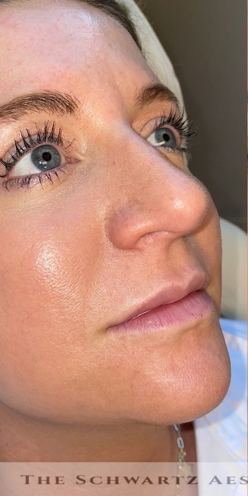 Lip Enhancement Before & After Gallery - Patient 179684 - Image 5