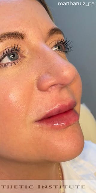 Lip Enhancement Before & After Gallery - Patient 179684 - Image 6