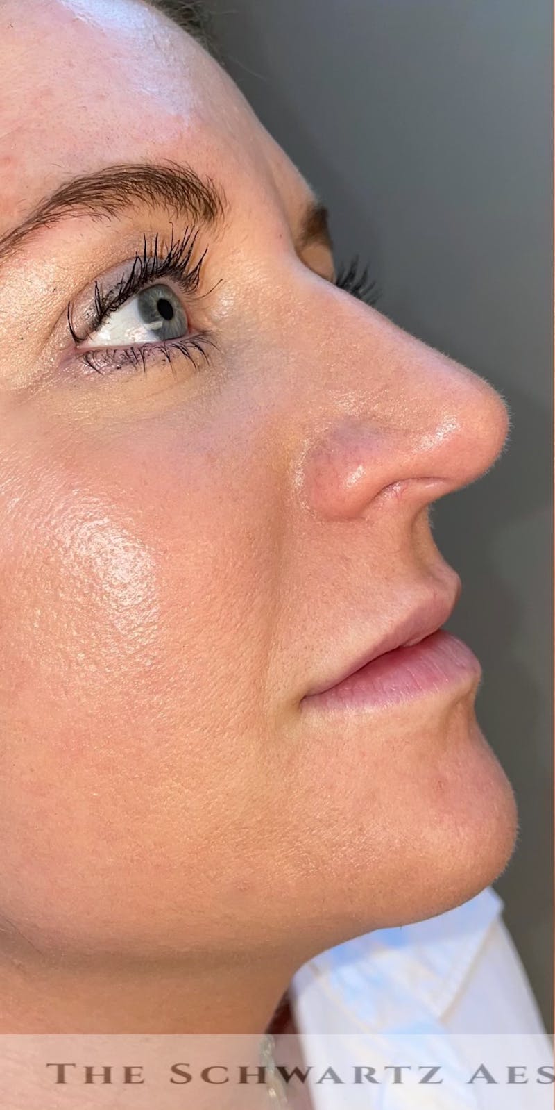 Lip Enhancement Before & After Gallery - Patient 179684 - Image 7