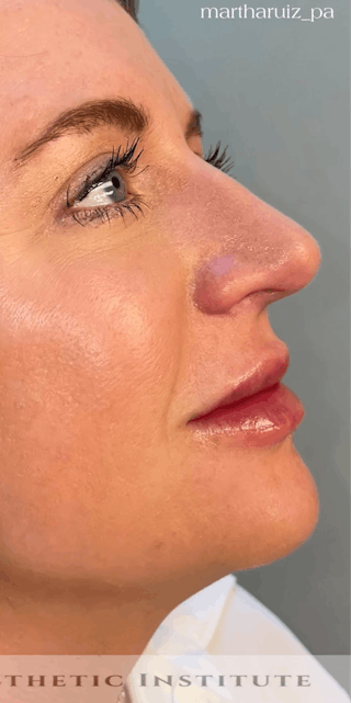 Lip Enhancement Before & After Gallery - Patient 179684 - Image 8
