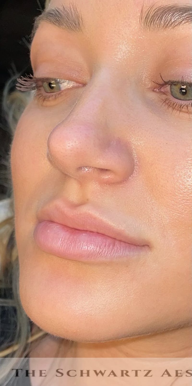 Lip Enhancement Before & After Gallery - Patient 377128 - Image 1
