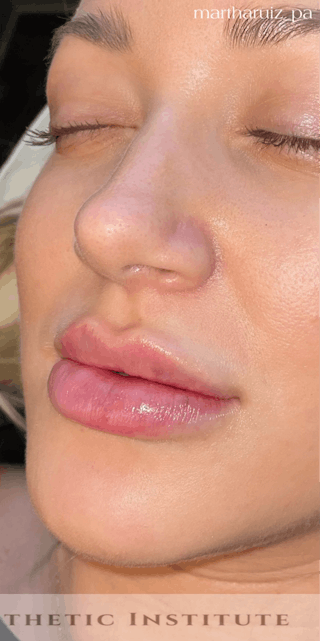 Lip Enhancement Before & After Gallery - Patient 377128 - Image 2